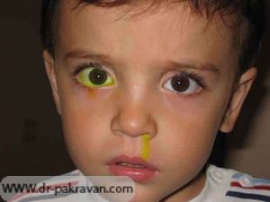 ریختن مایع رنگی فلورسین در هر دو چشم: مایع از مجرای باز (چشم چپ) وارد بینی شده ولی به علت انسداد مجاری چشم راست در داخل چشم تجمع یافته است.